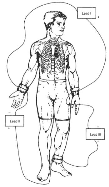 ECG Figura 2
